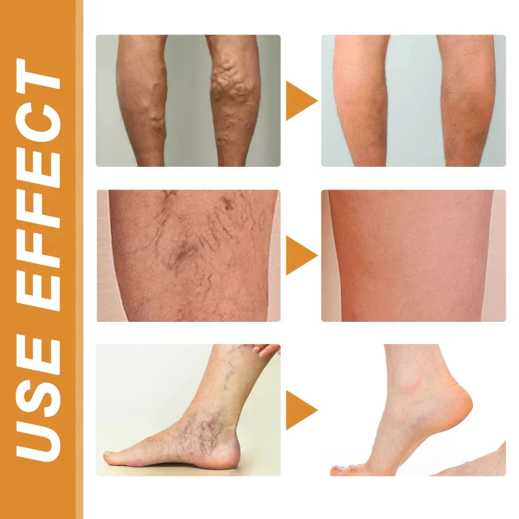 Varicose Veins Spray – Natural Herbal Formula for Fast Relief